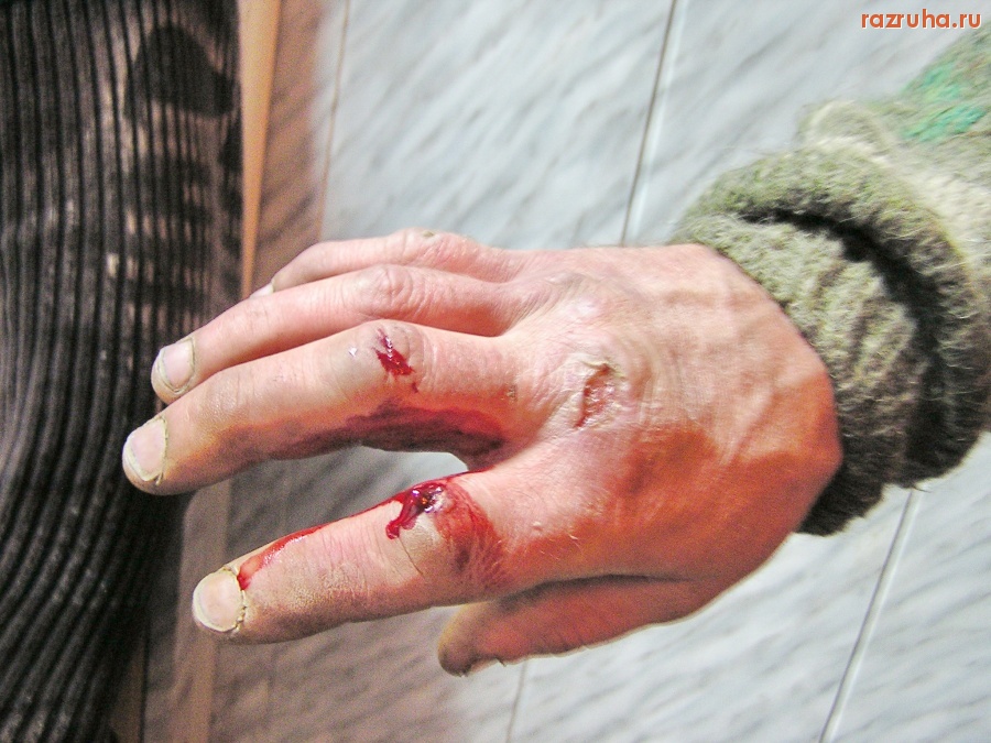 Санкт-Петербург - РУКА КЛОШАРА, ИЗБИТОГО МЕНТАМИ, ВО ВРЕМЯ ЗАЧИСТКИ